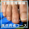 N78.美爪育成コースの施術事例３「N78.美爪育成コースの施術事例」