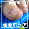 陥入爪施術事例No.86ー４「痛くて角を伸ばせなかったお爪をきれいに補正　陥入爪施術事例No.86」