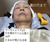 76才でも引き締め「人気の美容鍼と中国地方初のサーモシェイプでVフェイス」