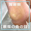 No.58たこ・魚の目の施術事例３「No.58芯までとるたこ・魚の目の施術事例」