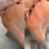 足裏角質ケア
