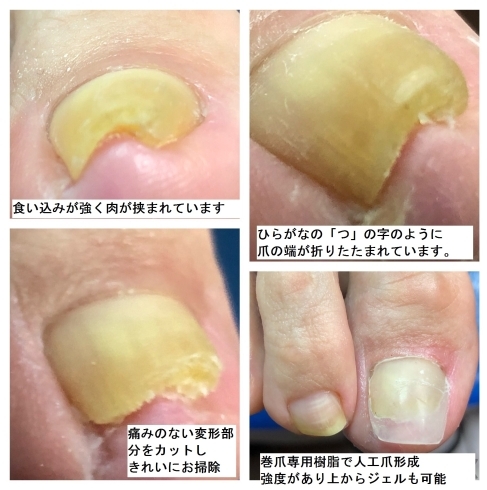 巻爪の痛い部分を取り除きその日のうちに痛みから解放「フットネイル半額！！当店イチオシ！フットケアＤＸをされた方はフットネイルが半額に！巻爪・トラブル爪もご相談ください❤」