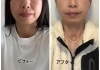 浮腫が取れて輪郭が綺麗になりました(1回目)「能見台駅から徒歩2分Pearlbliss(ﾊﾟｰﾙﾌﾞﾘｽ)」