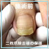 二枚爪！除去後はコーティングし割れ欠けを防止3「二枚爪！除去後はコーティングし割れ欠けを防止　No.101」