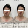 「劇的ビフォーアフター（両頬編）【福井エステサロン/福井小顔/福井ハーブピーリング/福井ハイフ】」