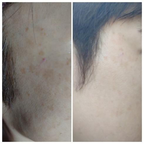 小顔 たるみ 毛穴の黒ずみ 書ききれないー グラ モーレのニュース まいぷれ 松江