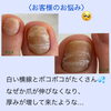 〈before〉横線が爪をにごった印象に…「トラブル爪のフットネイルケア①」