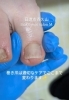 「歩くたびにズキッ…巻き爪のお悩みは早めのケアを」