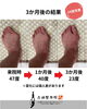 「【症例】3か月で外反母趾47°→23°へ｜草津市・60代女性」