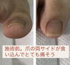 「巻爪ケア1回めでここまで変わる❗️」