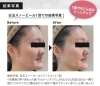 ホワイトスノーピール効果写真「夏のくすみ肌を生き返らせませんか？〜たった1回でも実感できる”透明感ケア”」