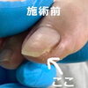 No.51陥入爪「角が痛くて爪が伸ばせない」３「No.51陥入爪「角が痛くて爪が伸ばせない」」