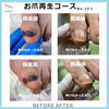 お爪再生コースの８か月後　No.103-2「お爪再生コースの８か月後」
