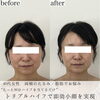 「劇的ビフォーアフター（両頬編）【福井エステサロン/福井小顔/福井ハーブピーリング/福井ハイフ】」