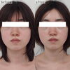 ハイフなしでもここまで変わる「アプリでのクマ消しはもうやめませんか？【福井ハイフ/福井切らないクマ取り/福井フェイシャルエステ/福井ハーブピーリング】」