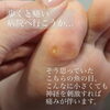 「足のトラブルはプロにお任せ！うおのめ除去☆【福井市　ネイルサロン】」