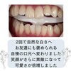アフター「メディカルホワイトニングお客様変化⭐︎」