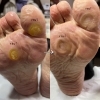 「【胼胝、魚の目ケア】」