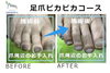 No.55爪切りの施術事例２「No.55爪切りの施術事例」