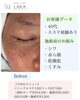「目尻のシワに変化＊ソニックエステ12回の施術前後をご紹介」
