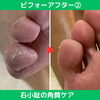劇的解消！角質ケア②「劇的解消！角質ケアのビフォーアフター【外反母趾や巻き爪、足の悩み専門整体/千葉県船橋市西船徒歩2分】」