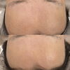 くすみのない透明感溢れるおでこへ「手も細胞から蘇り若々しいなる【素肌復元フェイシャル/福井フェイシャルエステ/福井エイジングケア】」
