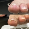ジェルネイルで巻き爪ケア　親指2本