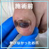 お爪再生コースの８か月後　No.103-3「お爪再生コースの８か月後」