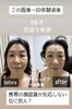 小顔効果最強「人気の美容鍼と中国地方初のサーモシェイプでVフェイス」