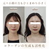 「《 小顔と美肌 》両方手に入る🥰【 福井 / エステ / ハイフ / トリプルハイフ / ラジオ波 / EMS / リフトアップ / 小顔 / ポレーション / ハリ艶 】」