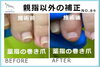 薬指の矯正写真５「薬指も巻き爪の矯正が出来ますか？」