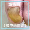 No.56病院で断られた爪甲鉤彎症のケア３「No.56病院で断られた爪甲鉤彎症のケア」