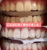 別人級に変わりました「メディカルホワイトニング」