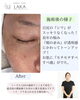 「目尻のシワに変化＊ソニックエステ12回の施術前後をご紹介」