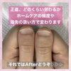 「まむし指が改善できる！【福井市ネイルサロン/自爪育成】」