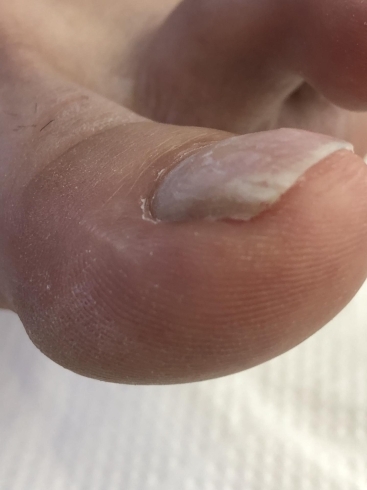 ネイルトリム 導入 巻爪の痛みにサヨナラしたい半額モニター様募集します Nail Foot Care Private Salon Macaron マカロン のニュース まいぷれ 松江 ネイルトリム 導入 巻爪の痛みにサヨナラしたい半額モニター様募集します Nail Foot Care Private Salon Macaron マカロン のニュース まいぷれ 松江