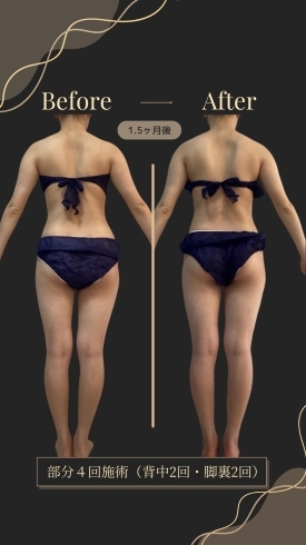背中のゆがみや腰周りにも変化が👏「頑張らずに【本気で痩せたい!変えたい!次こそは!という方🙌】松山市のエステサロンTiAMではボディエステの結果にこだわります😍早く痩せたいけど頑張れない…という方お任せください!プロの施術をプライベート空間で🥰」
