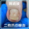 二枚爪のケア　No.97ー４「二枚爪のケア　No.97」