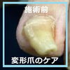 切ることが出来なくなってしまった爪 No.91ー３「自分で切ることが出来なくなってしまった爪 No.91」