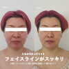 お肌にハリ・ツヤ・弾力も出ます🙆‍♀️「直後からの圧倒的変化に驚愕😍✨【福井エステ/福井ハイフ/福井小顔】」