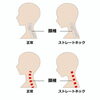 頭痛の原因はストレートネック「要注意！子どもの頭痛【宮崎市で頭痛の治療ができる整骨院】」