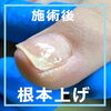 「巻き爪のおすすめのケア「根本上げ」」