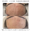 「ハーブ劇的ビフォーアフター(ニキビ・ニキビ跡編)【 福井フェイシャルエステ/ 福井美肌/ 福井ハーブピーリング 】」