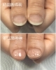 短指症 マムシ指 でも自爪育成 福井市 ネイルサロン コンプレックス Nail Melia Medical Healthcare のニュース まいぷれ 福井