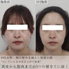 「劇的ビフォーアフター（両頬編）【福井エステサロン/福井小顔/福井ハーブピーリング/福井ハイフ】」