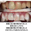 before after「差し歯があっても理想の白さへ！メディカルホワイトニングで自信の笑顔に」