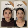 １年半経過のビフォアフ「小顔サロン　Lua cheia.Chapter2」