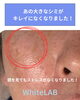「30年気になっていたシミのお悩みにも◎WhiteLABで消えました」