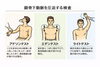 胸郭出口症候群のテスト法「手のしびれの原因は一つではありません。」