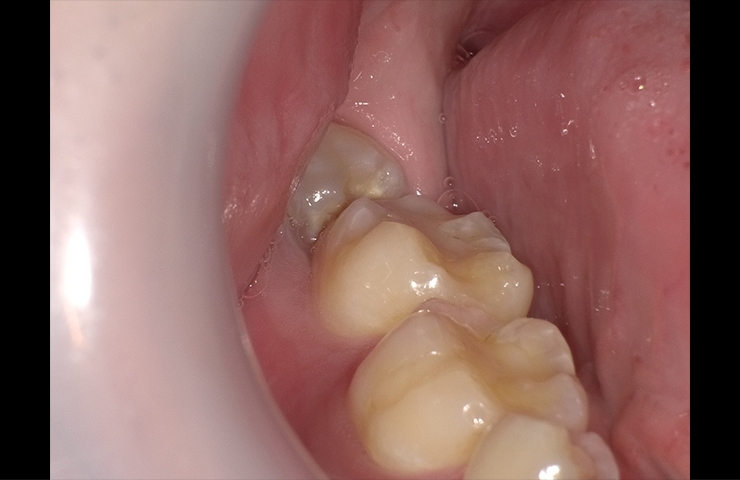 恐くない 痛くない 最新親知らず抜歯事情 町のドクターに聞く 健康豆知識 まいぷれ 新居浜市 恐くない 痛くない 最新親知らず抜歯事情 町のドクターに聞く 健康豆知識 まいぷれ 新居浜市